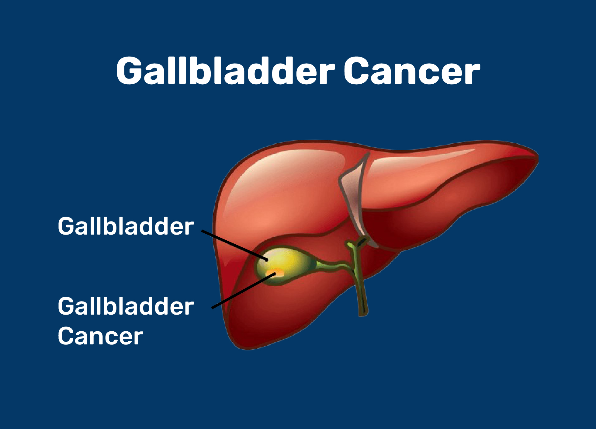 Gall Bladder Cancer