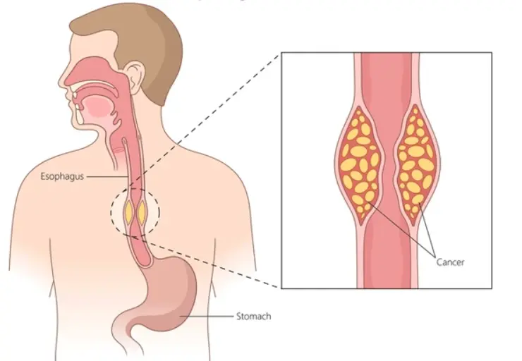 esophageal cancer awareness