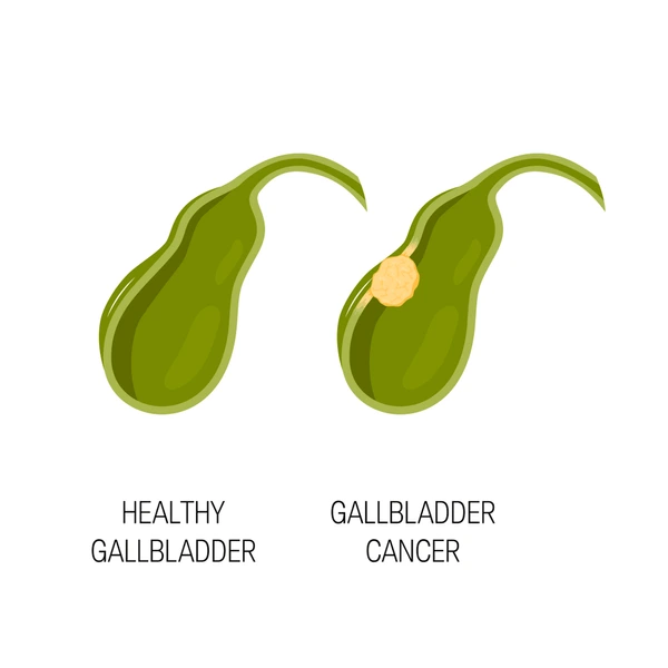 biliary-tract-disease-concept-medical