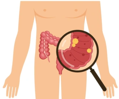 colorectal cancer image