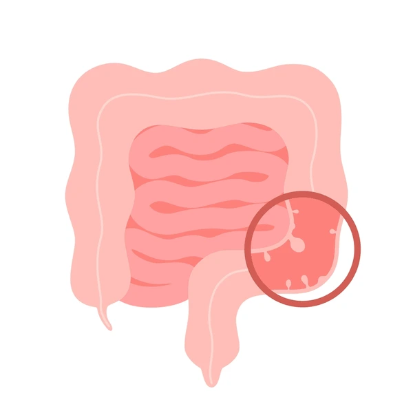 colonoscopy-intestine-polypectomy-procedure