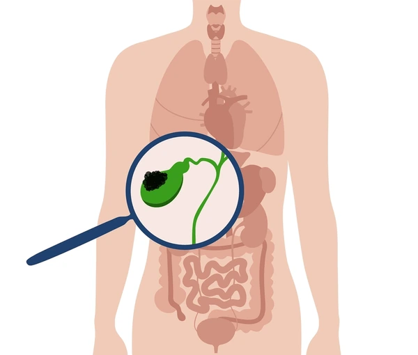 gallbladder-cancer