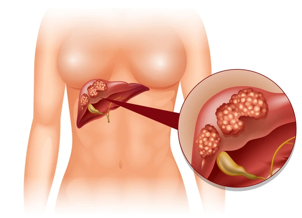 liver-cancer