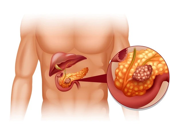 pancreas-cancer