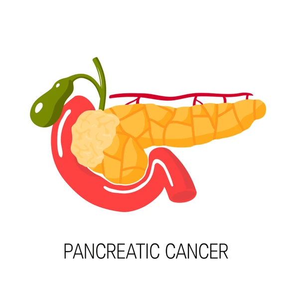 pancreatic-cancer