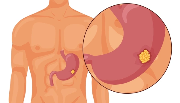 stomach cancer