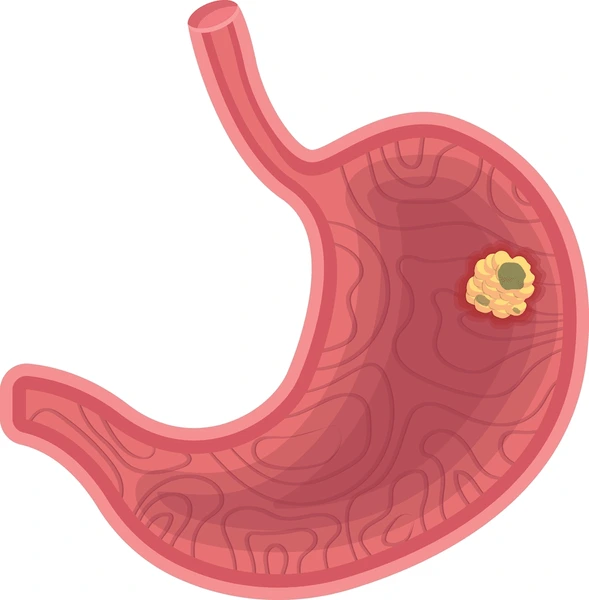 stomach cancer vector
