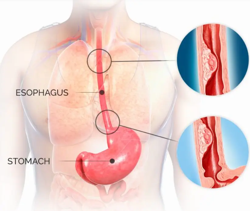 types of esophageal cancer awareness
