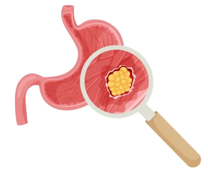 types of stomach cancer